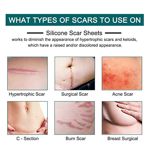 Silicone Scar Sheets Roll J530